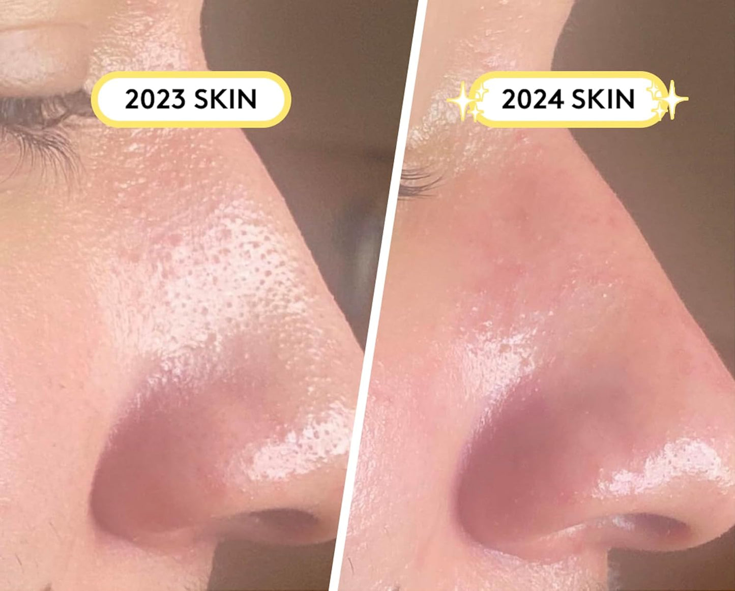SKIN CHOICE Nose Pore Strips - Patch Nasal Hydrocolloïde Pour Déboucher Et Rétrécir Les Pores, Éliminer Les Impuretés, L'Acné Et Les Boutons, Prévenir Les Points Noirs Végétalien (10 Unité)