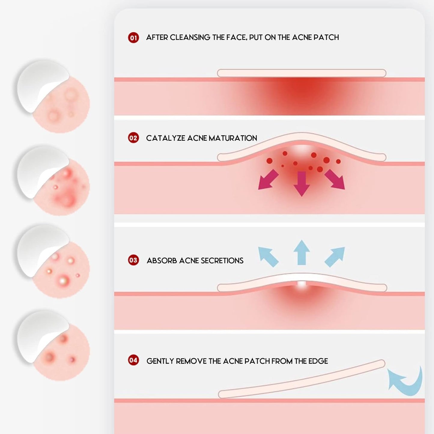 Rnitle Acné Patch,180 Patchs Pimple Patch,12Mm & 8Mm Patch Bouton Acne,Anti-Acné Patch, Patch Bouton, Autocollants Pour Boutons, Patch Invisible, Pour Soin De La Peau