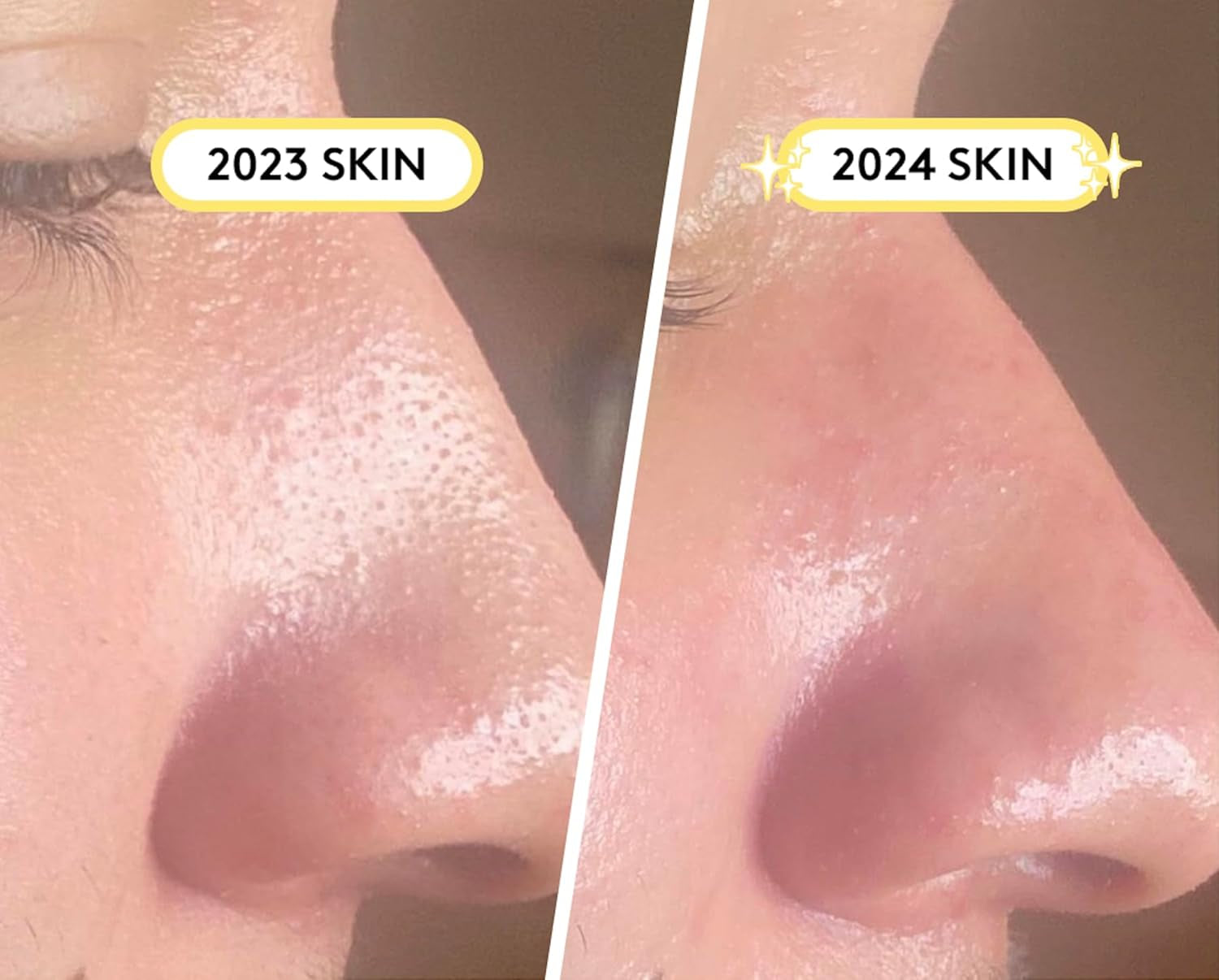 SKIN CHOICE Nose Pore Strips - Patch Nasal Hydrocolloïde Pour Déboucher Et Rétrécir Les Pores, Éliminer Les Impuretés, L'Acné Et Les Boutons, Prévenir Les Points Noirs Végétalien (10 Unité)