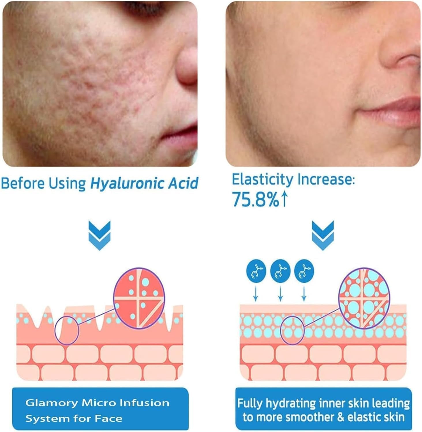 Système De Micro-Perfusion Pour Les Lèvres, Micro Système Pour Le Visage, Système Facial Avec Sérum, Rouleau De Microfléchettes À L'Acide Hyaluronique Pockmarksheal, Sérum Pour Peau Lisse (3 Pièces)