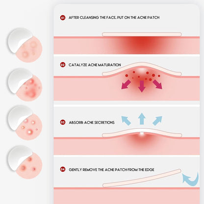 Rnitle Acné Patch,180 Patchs Pimple Patch,12Mm & 8Mm Patch Bouton Acne,Anti-Acné Patch, Patch Bouton, Autocollants Pour Boutons, Patch Invisible, Pour Soin De La Peau